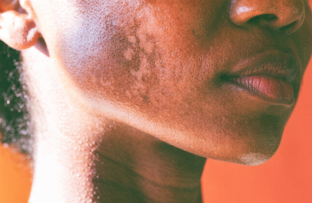 A close view of a cheek and jaw, showing natural uneven tone and faded marks.