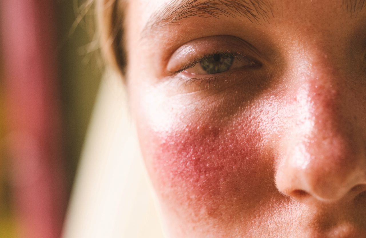 A close view of a cheek showing natural redness and irritation.